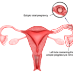 Discussing Ectopic Pregnancy (Pregnancy Outside the Womb)