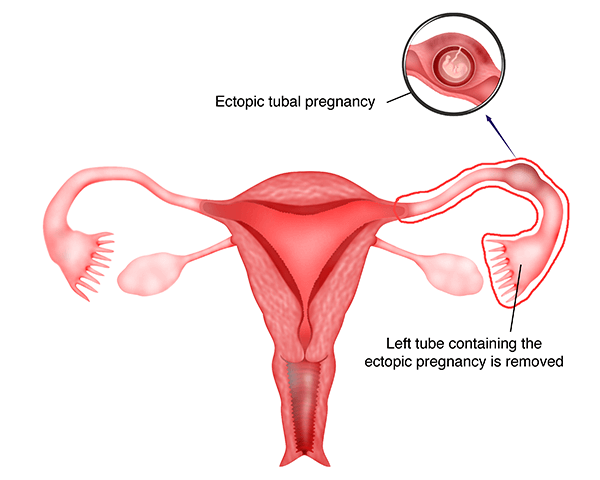 Discussing Ectopic Pregnancy (Pregnancy Outside the Womb)