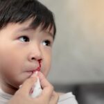 Understanding Nosebleeds and How to Treat Them