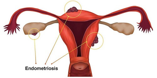 Understanding and How to Treat Endometriosis