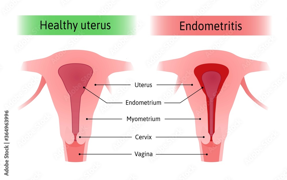 Understanding and How to Treat Endometritis