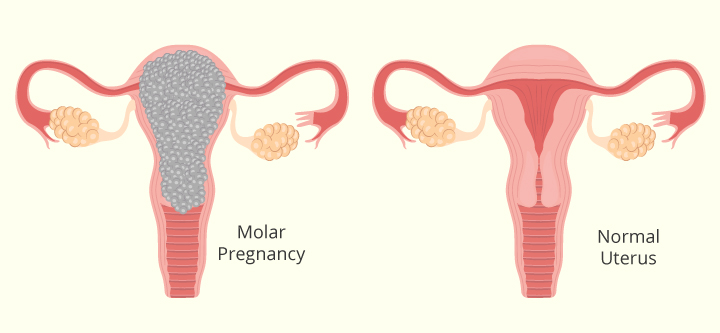 Understanding and How to Treat Molar Pregnancy (Hydatidiform Mole)