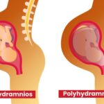 Handling Oligohydramnios or Low Amniotic Water During Pregnancy