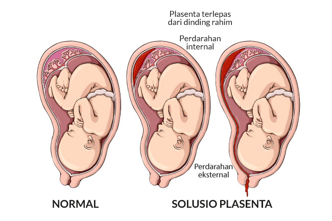 Understanding and How to Treat Placental Abruption