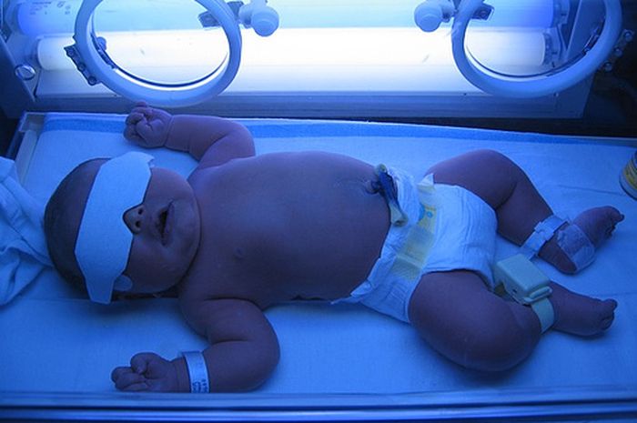 Understanding and How to Treat Hyperbilirubin in Newborn Babies
