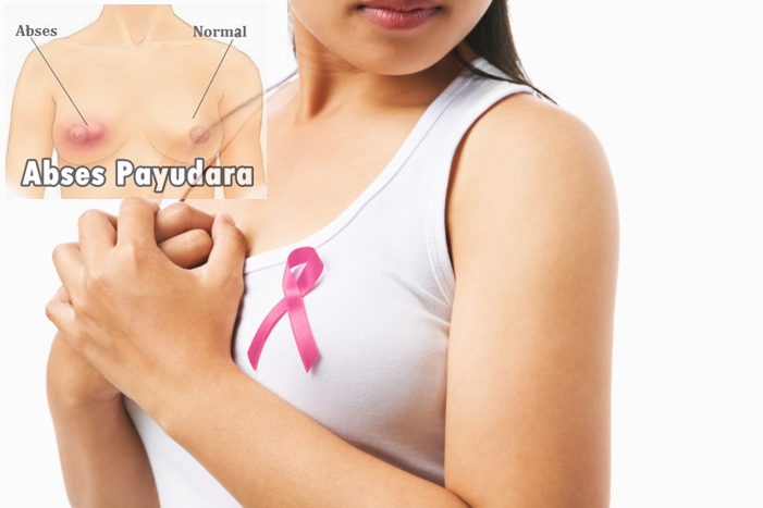 Understanding and How to Treat Breast Abscesses in Postpartum Women