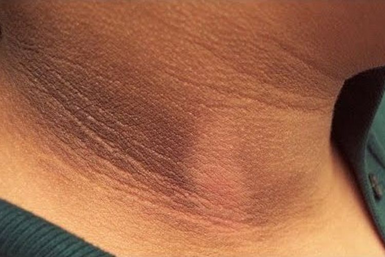 Discussing Hyperpigmentation (Blackened Skin) in Pregnant Women