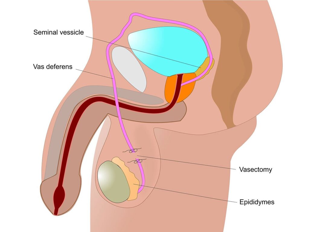Steady Contraception Vasectomy in Men to Prevent Pregnancy