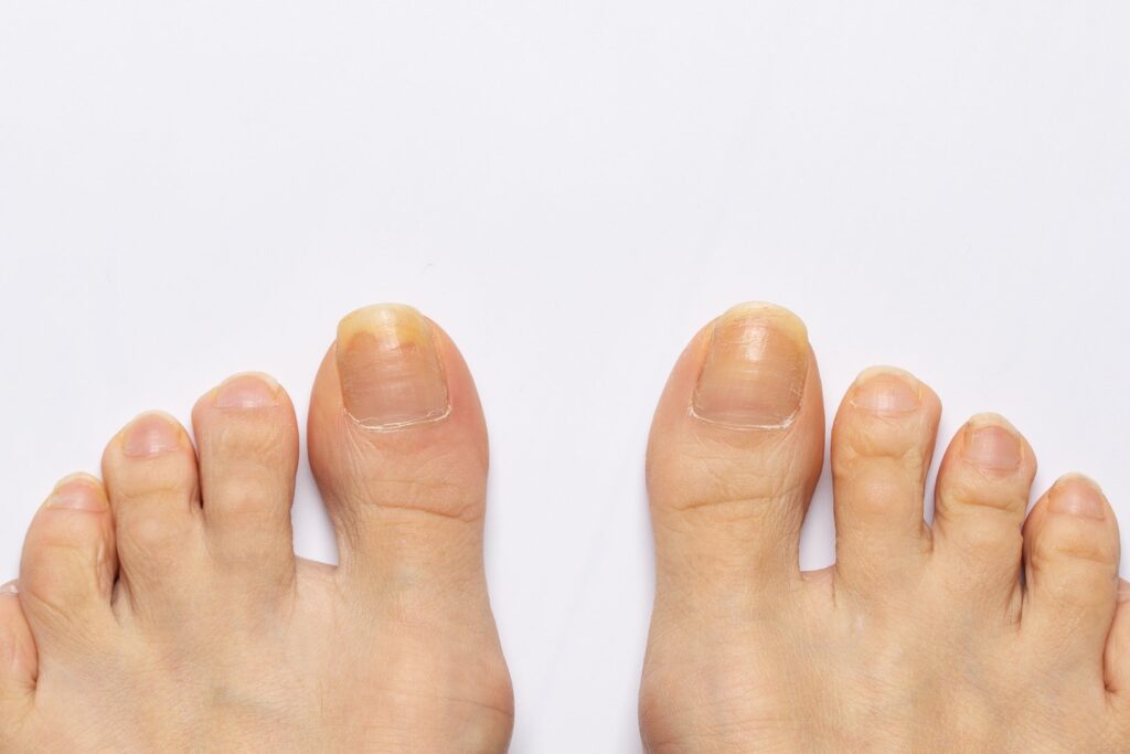 Some Possible Diseases Indicated by Yellow Nails