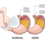 Explanation About GERD (Gastroesophageal Reflux Disease)