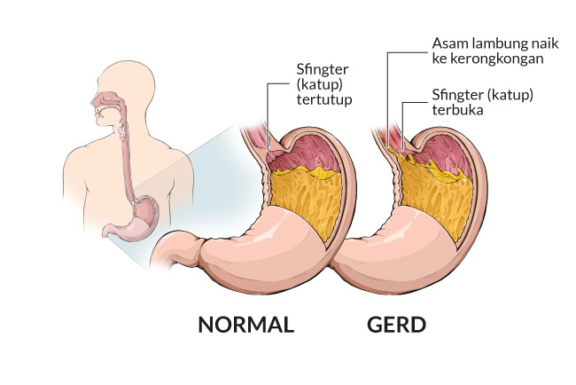 Explanation About GERD (Gastroesophageal Reflux Disease)