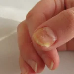 Causes of Yellow Nail Syndrome and Its Treatment