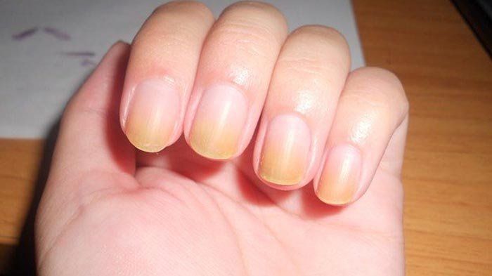 Causes of Yellow Nails and How to Treat Them