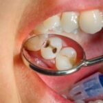 Understanding Cavities