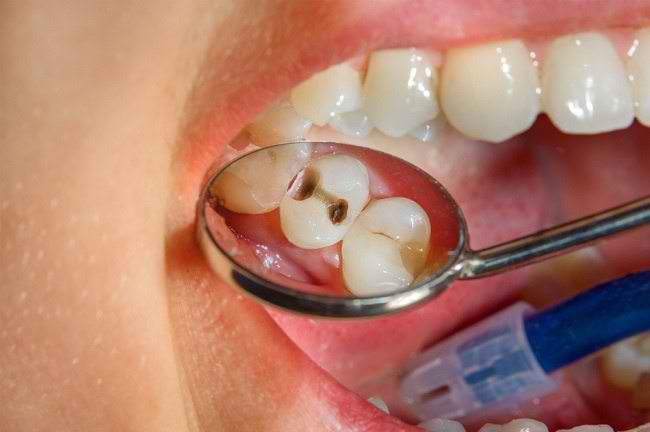 Understanding Cavities