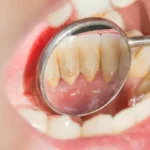 Understanding Dental Plaque and How to Prevent It