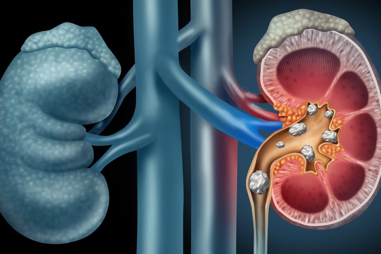 Understanding and How to Treat Kidney Stones or Nephrolithiasis