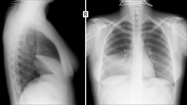 TB Pleura: Penyakit Tuberkulosis yang Menyerang Selaput Paru